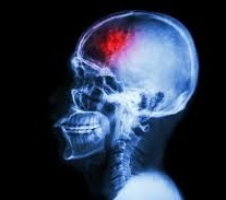 It is likely to become standard practice after a stroke to screen patients for insulin resistance.