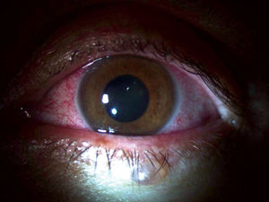 A patient that had contracted the Ebola virus in Liberia developed uveitis during convalescent stage.
