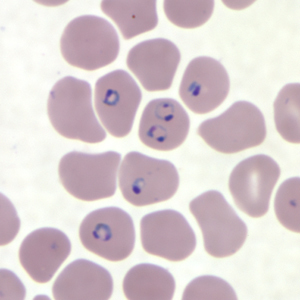 Rings of a malaria infected sample of blood