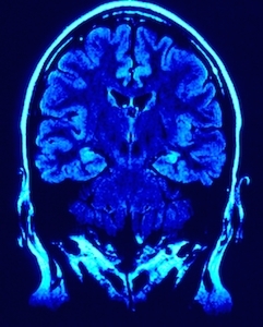 Nearly all of the neurological abnormalities were resolved on MRI scans taken seven months after his admission.