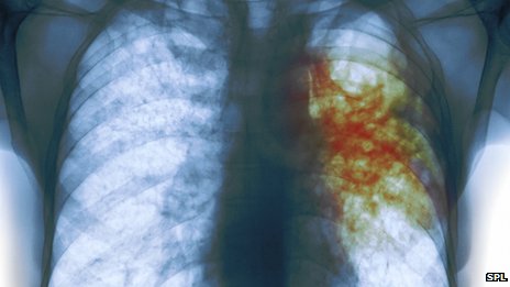 New strategy to treat tuberculosis