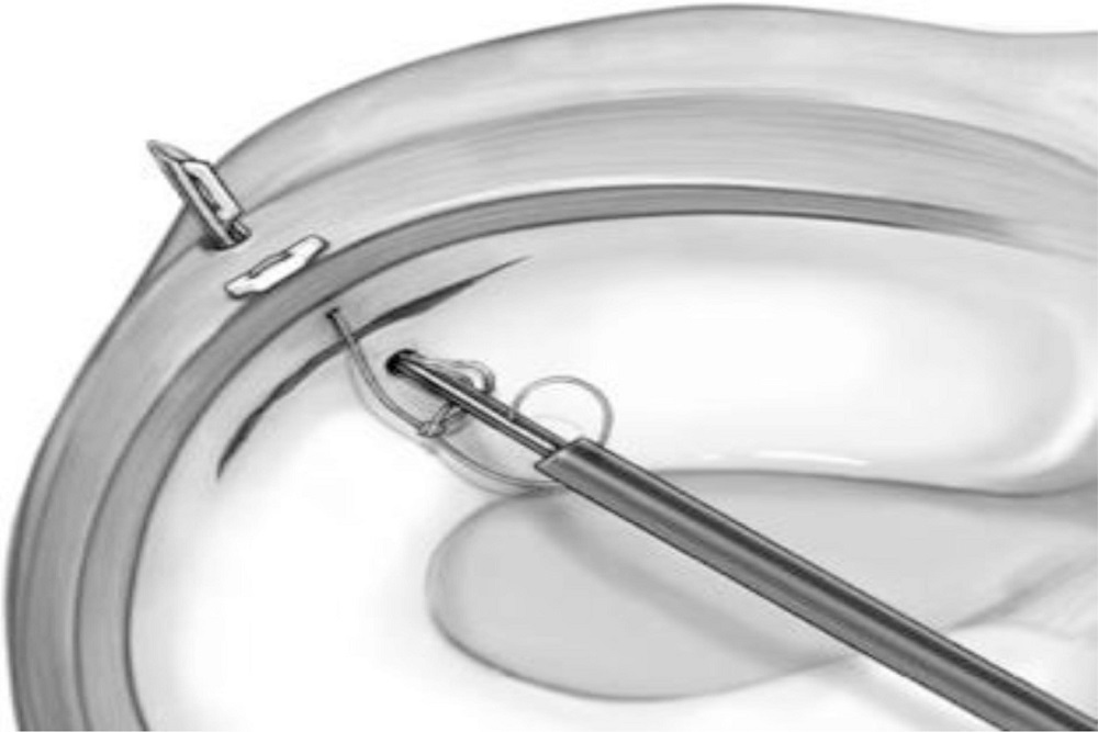 ZIMMER BIOMET Receives FDA Clearance of JuggerStitch™ Meniscal Repair Device FDA Reporter