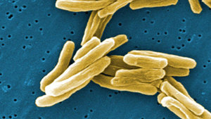 CDC introduces action plan to combat tuberculosis.