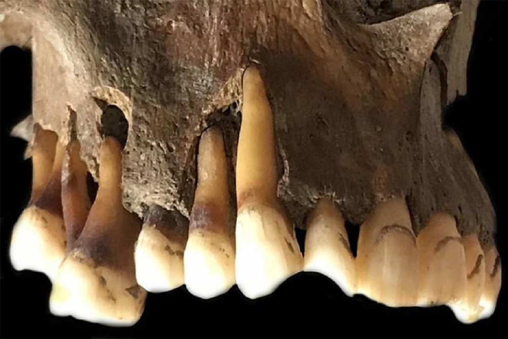 Prehistoric Roots of ‘Cold Sore’ Virus Traced Through Ancient Herpes