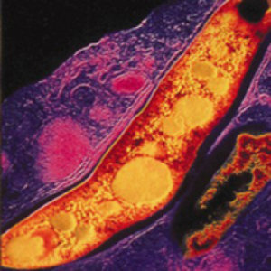 Blood-based biomarkers allow better TB diagnosis and observance