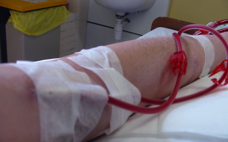 There are currently more than 100,000 Brazilians on dialysis.