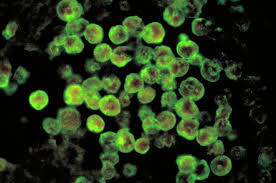 Officials investigate suspected primary amebic meningoencephalitis case in Minnesota