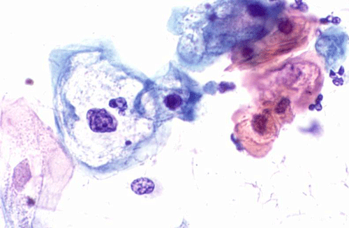 HPV vaccination increases with electronic health record prompts.