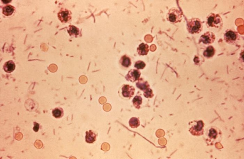 Indiana has seen more than 10 times as many shigellosis cases this year compared with 2013.