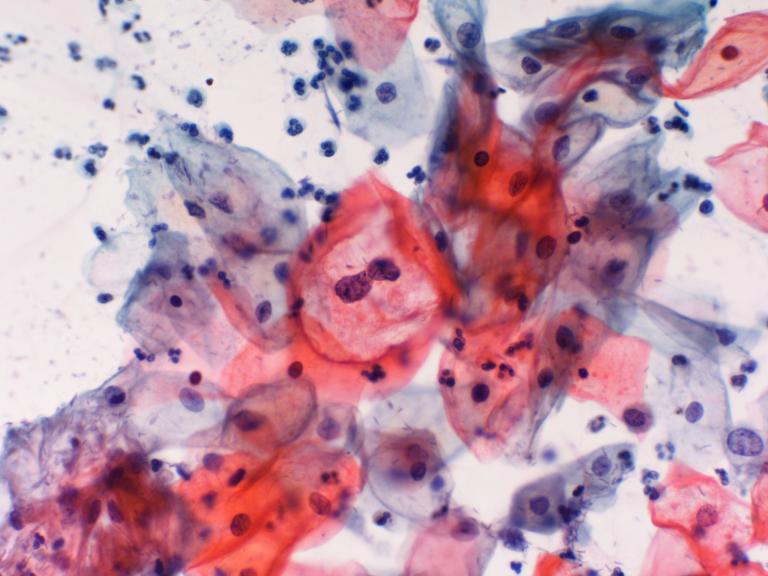 ORYX trial successful for HPV-associated cancer vaccine.