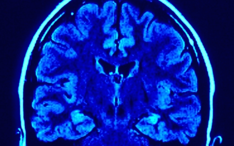 CTE is associated with abnormal aggregations of tau protein in the brain.