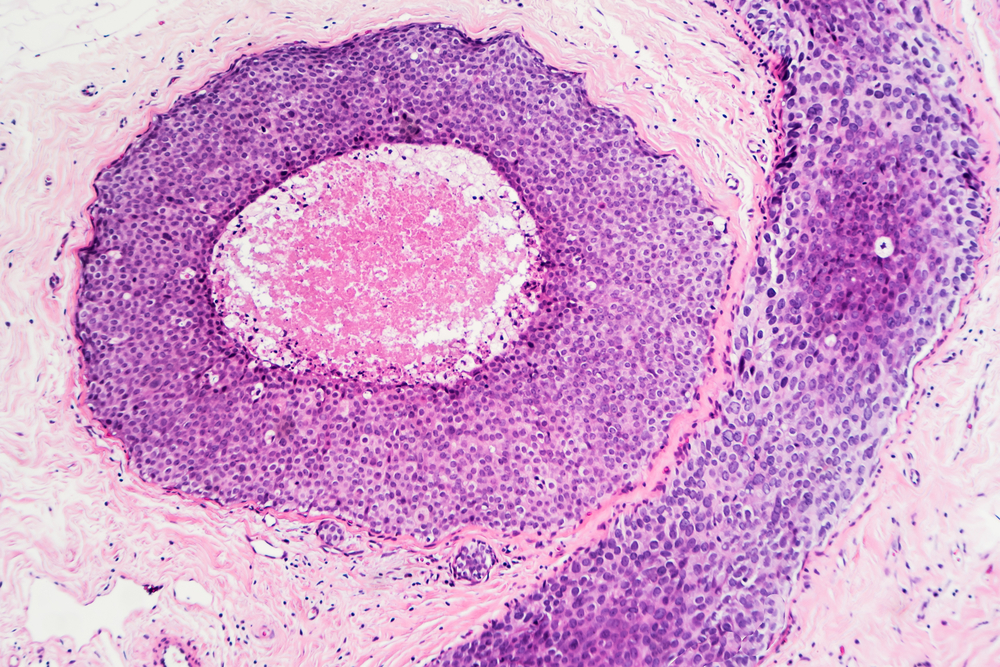 The FDA’s approval comes after the conclusion of the Javelin Markel 200 trial.