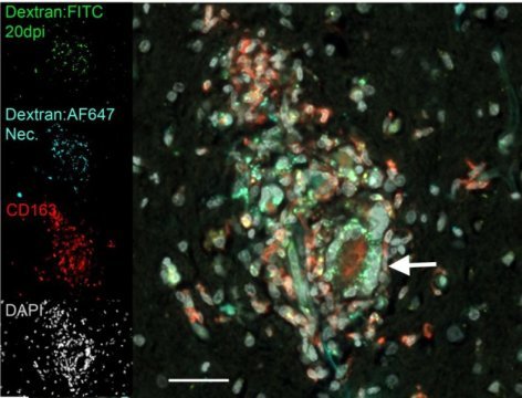 Study results concerning neurological damage from HIV
